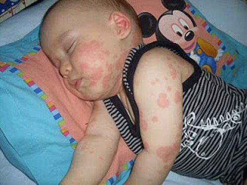 bebeklerde gida alerjisi nasil gecer belirtileri tedavisi